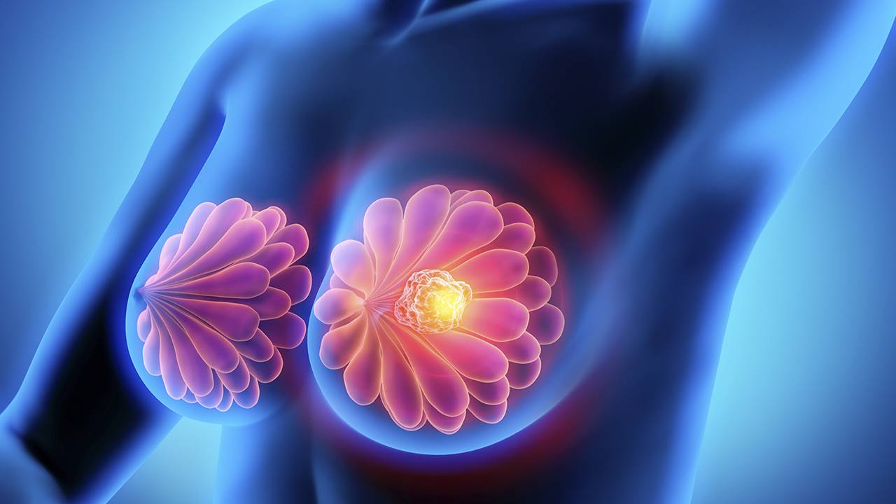 , ¿Sabes cuál es tu riesgo de desarrollar cáncer de mama?, Grupo Residencial
